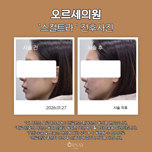 스컬트라 시술 전과 시술 직후 90도 측면 사진 2026.01.27