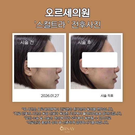 스컬트라 시술 전과 시술 직후 반대쪽 90도 측면 사진 2026.01.27