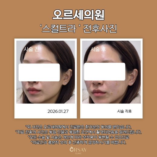 스컬트라 시술 전과 시술 직후 45도 측면 사진 2026.01.27