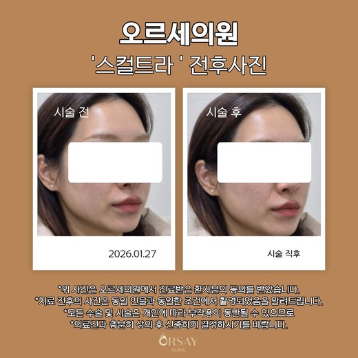 스컬트라 시술 전과 시술 직후 반대쪽 45도 측면 사진 2026.01.27