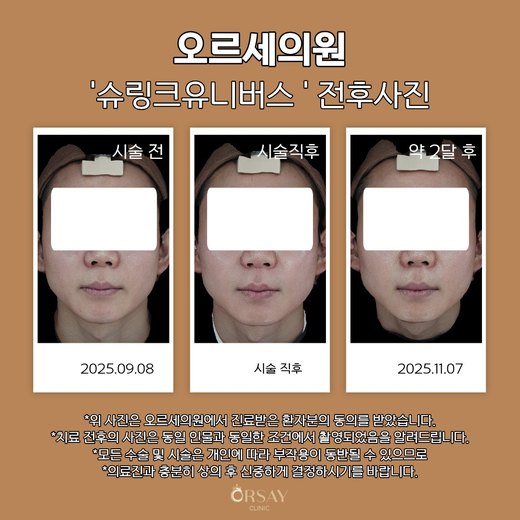 슈링크유니버스 시술 전, 직후, 약 2달 후 정면 사진 (2025.09.08, 2025.11.07)