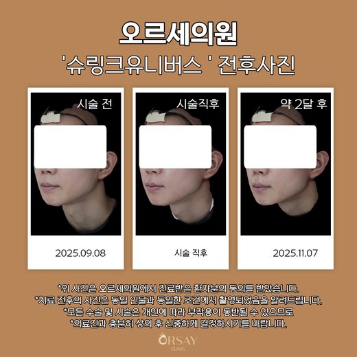 슈링크유니버스 시술 전, 직후, 약 2달 후 45도 측면 사진 왼쪽
