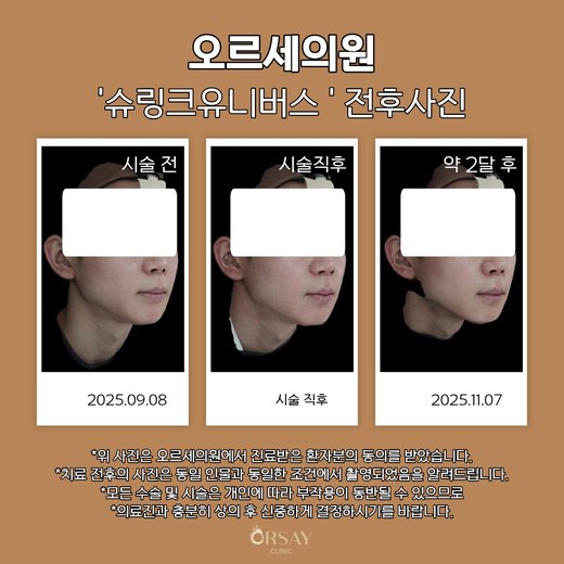 슈링크유니버스 시술 전, 직후, 약 2달 후 45도 측면 사진 오른쪽
