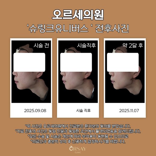 슈링크유니버스 시술 전, 직후, 약 2달 후 90도 측면 사진 왼쪽
