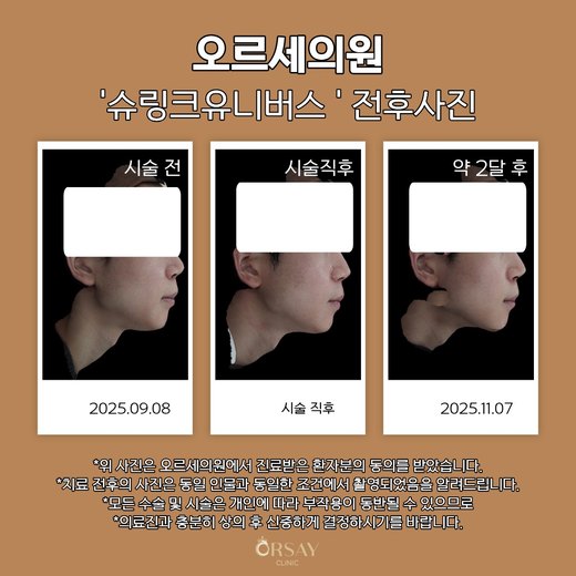 슈링크유니버스 시술 전, 직후, 약 2달 후 90도 측면 사진 오른쪽