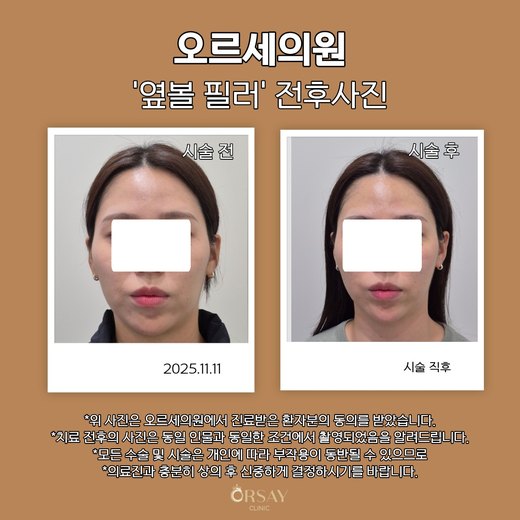 옆볼 필러 시술 전과 직후 정면 사진 2025.11.11