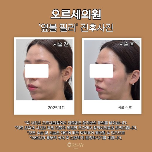 옆볼 필러 시술 전과 직후 45도 측면 사진(왼쪽) 2025.11.11