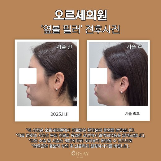 옆볼 필러 시술 전과 직후 90도 측면 사진(왼쪽) 2025.11.11