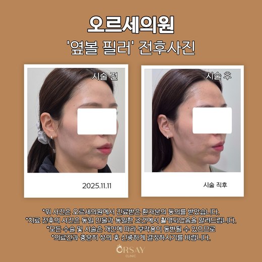 옆볼 필러 시술 전과 직후 45도 측면 사진(오른쪽) 2025.11.11