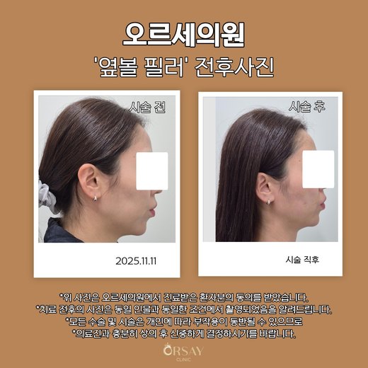 옆볼 필러 시술 전과 직후 90도 측면 사진(오른쪽) 2025.11.11