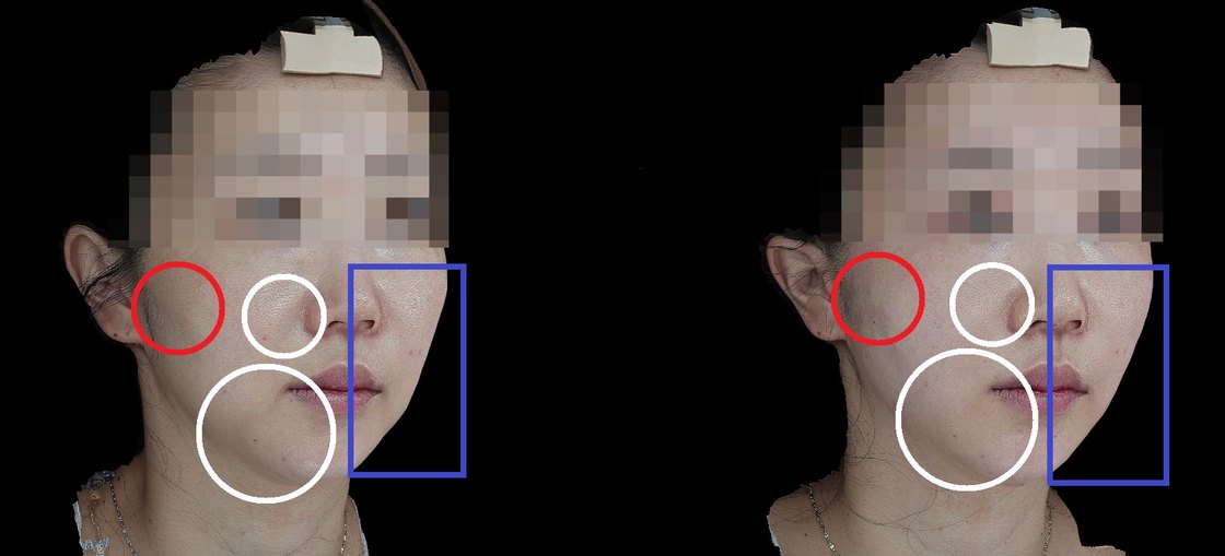 실루엣소프트 시술 전과 시술 후 2주 경과 비교