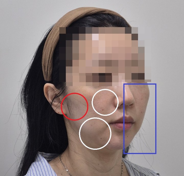 실루엣소프트 리프팅 기대효과