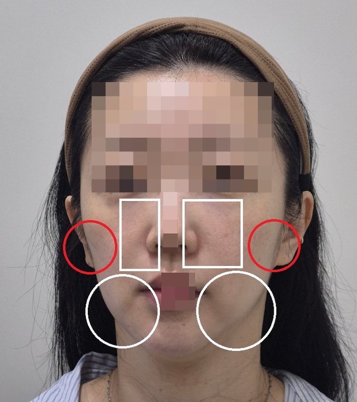 오르세의원 실루엣소프트가 적합한 시술 케이스