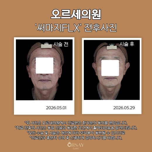 써마지FLX 전후사진
