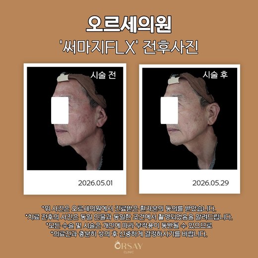 써마지FLX 전후사진