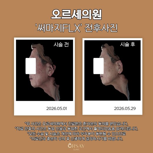 써마지FLX 전후사진