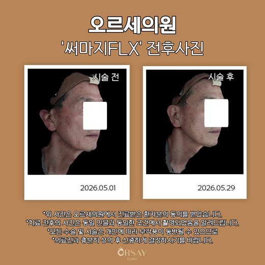 써마지FLX 전후사진