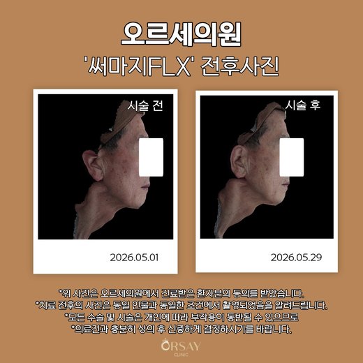 써마지FLX 전후사진