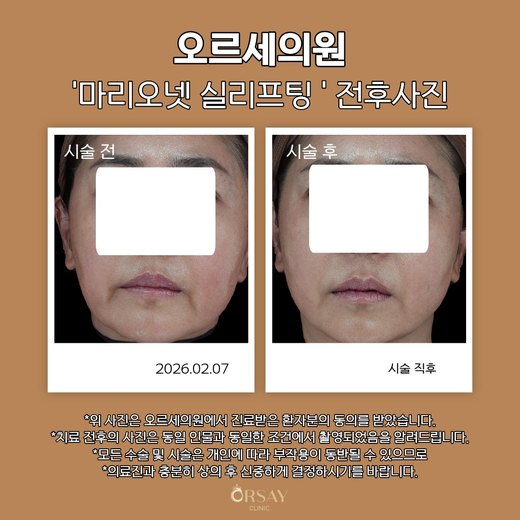 실리프팅 전후사진