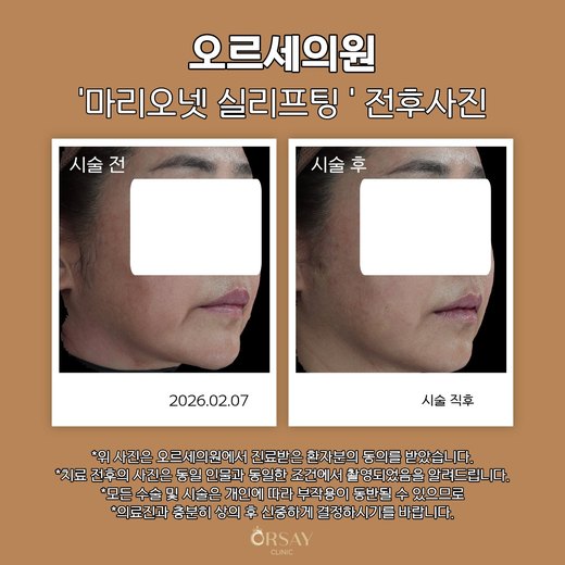 실리프팅 전후사진