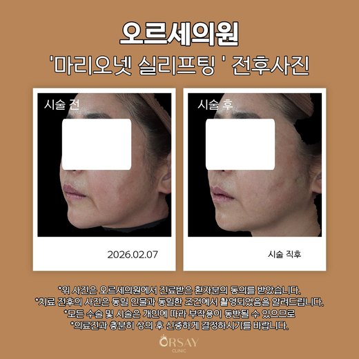 실리프팅 전후사진