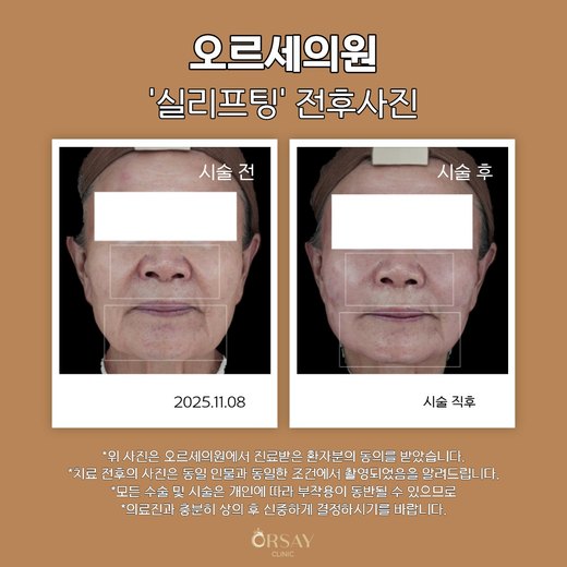 실리프팅 전후사진