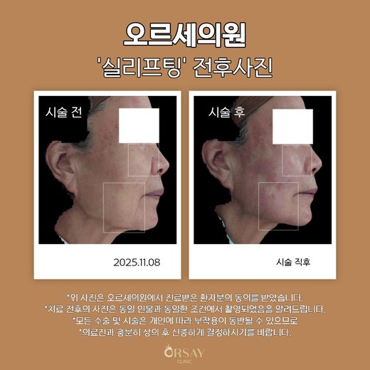 실리프팅 전후사진