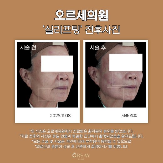 실리프팅 전후사진