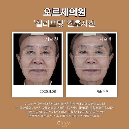 실리프팅 전후사진 2025.11.08