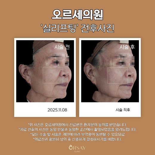 실리프팅 전후사진 2025.11.08