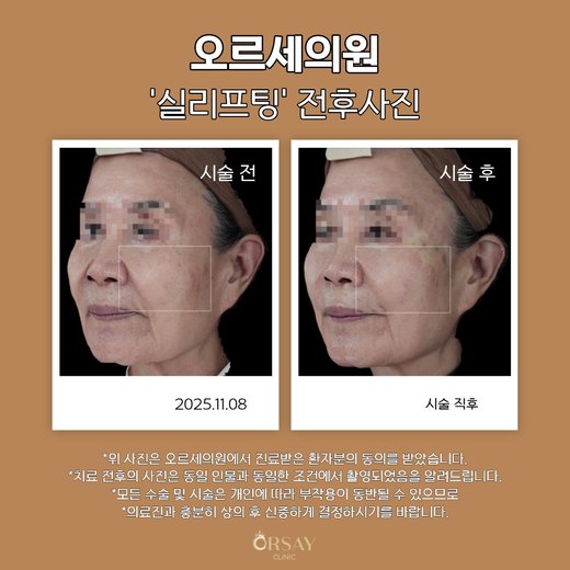 실리프팅 전후사진 2025.11.08