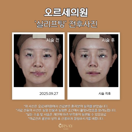 코 실리프팅 전후사진