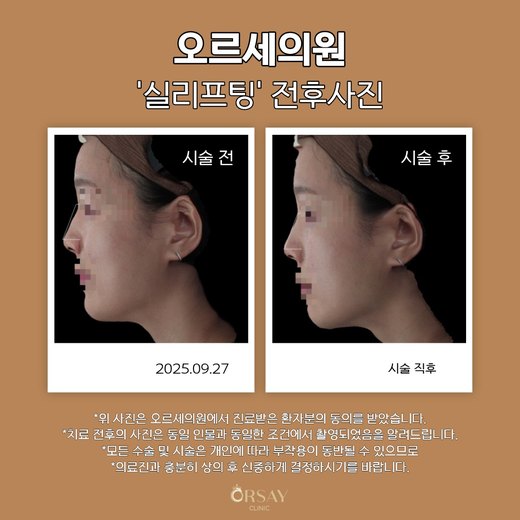코 실리프팅 전후사진