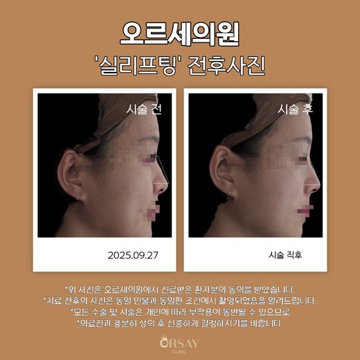 코 실리프팅 전후사진