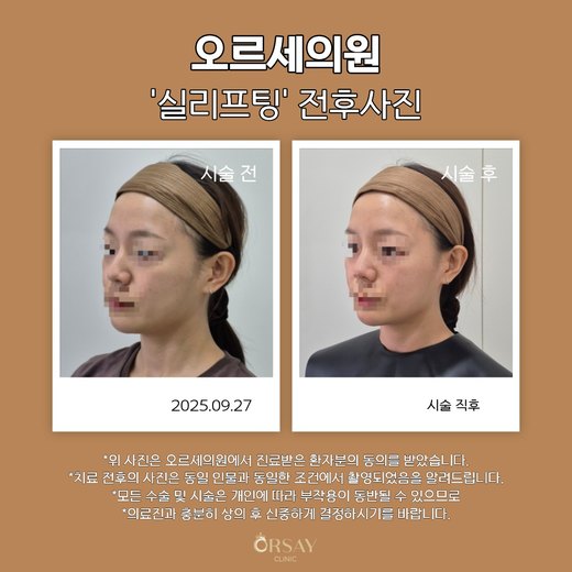 코 실리프팅 전후사진