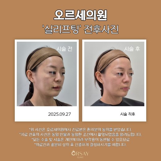 코 실리프팅 전후사진