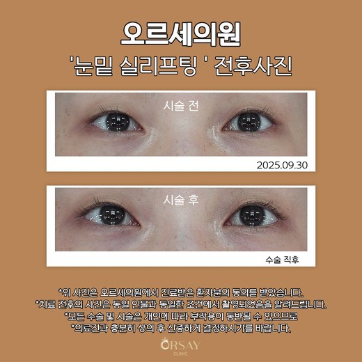 눈밑 실리프팅 전후사진
