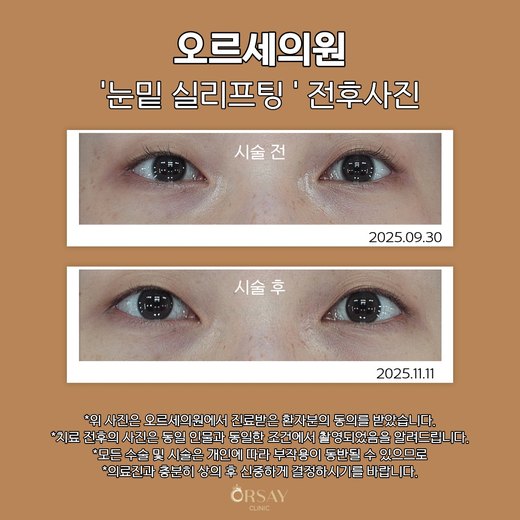 눈밑 실리프팅 전후사진