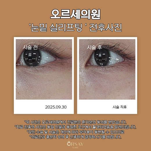 눈밑 실리프팅 전후사진