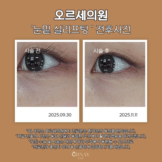 눈밑 실리프팅 전후사진