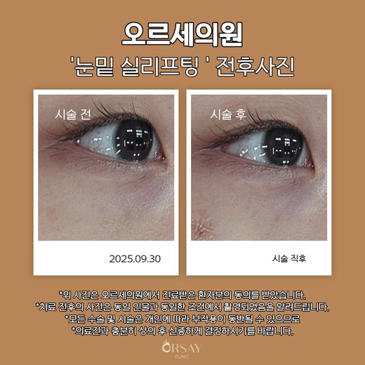 눈밑 실리프팅 전후사진