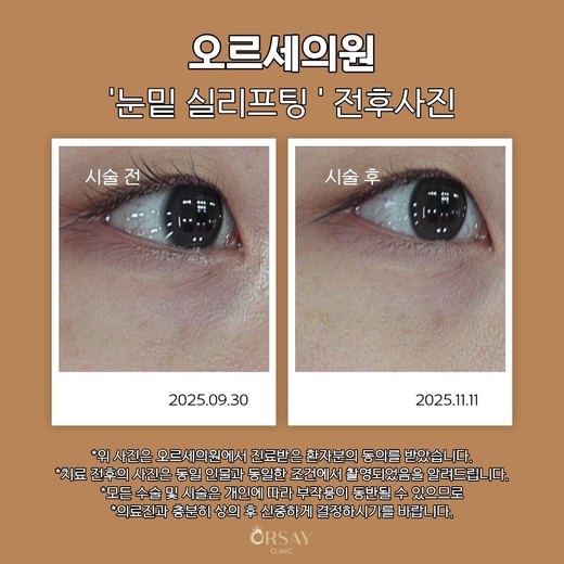 눈밑 실리프팅 전후사진