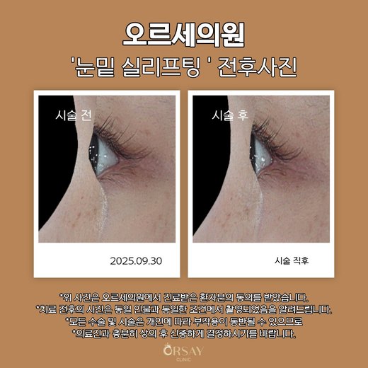 눈밑 실리프팅 전후사진