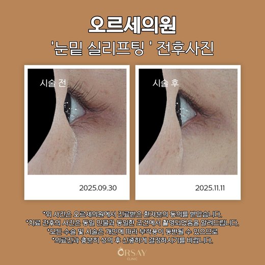 눈밑 실리프팅 전후사진