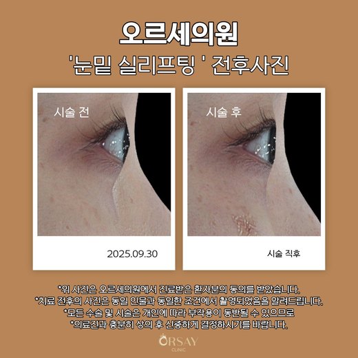 눈밑 실리프팅 전후사진