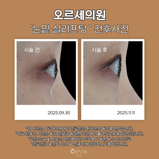 눈밑 실리프팅 전후사진