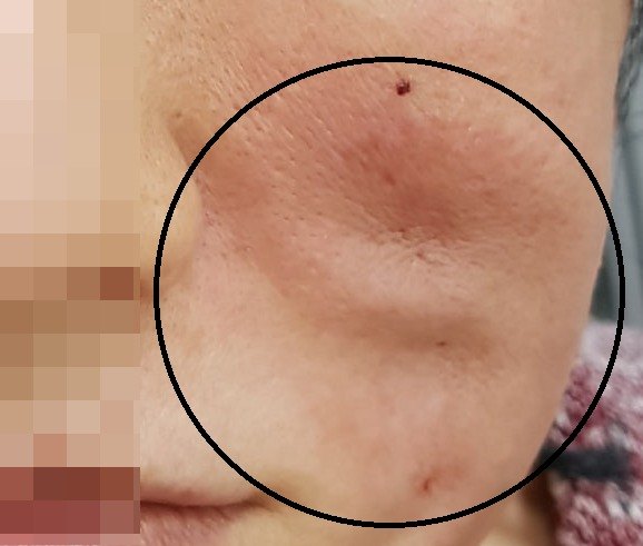실리프팅 후 딤플 사례