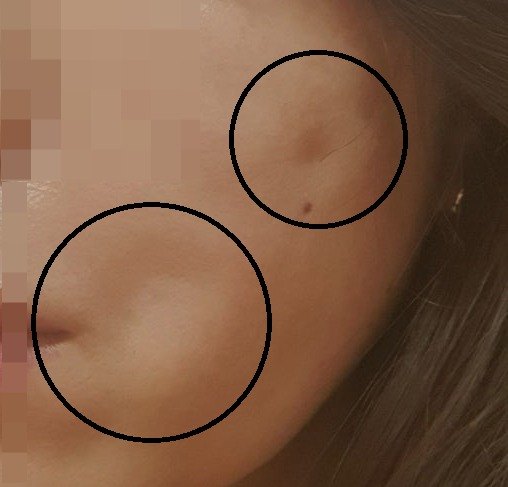 입가 딤플 사례